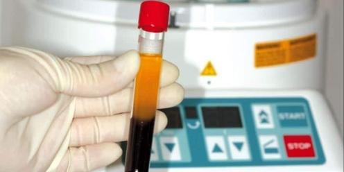 Phlebotomy techniques and the process of creating BC-PRP and PRF
